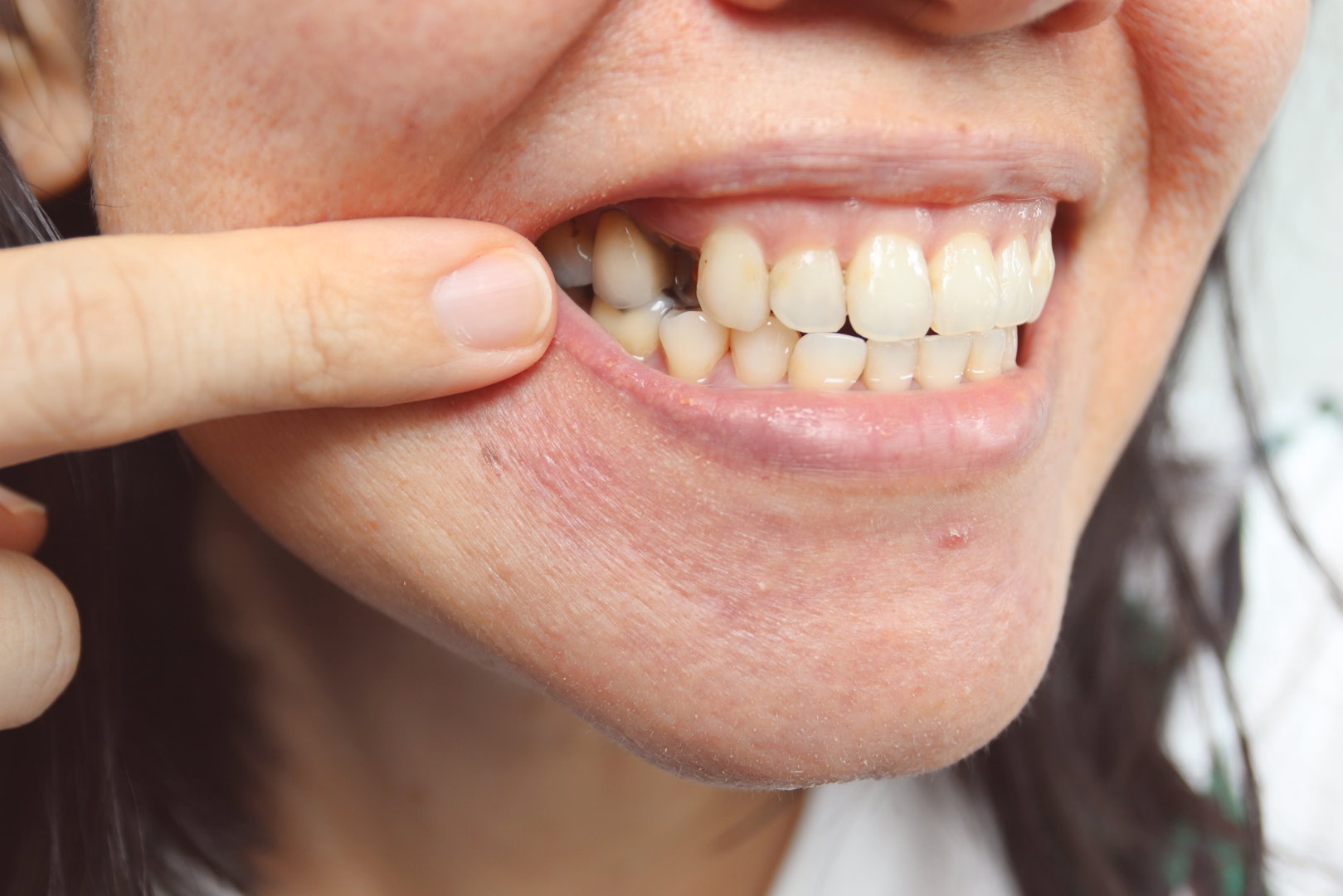 Dental Implant Procedure FAQs